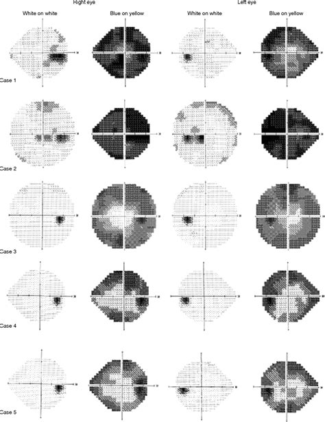 Automated achromatic perimetry .